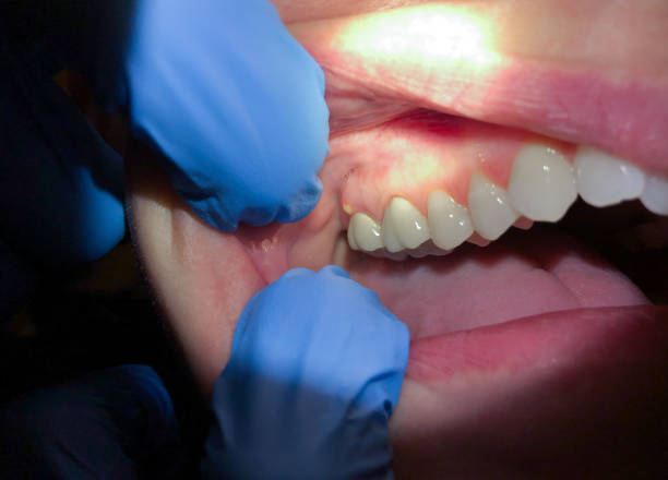 Best Emergency Tooth Extraction in East Dubuque, IL